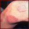 Leprosy