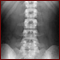 Renal-Stones
